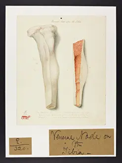 Venereal: Venereal Node upon the Tibia