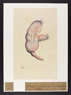 Blank: Venous Congestion and Inflammation