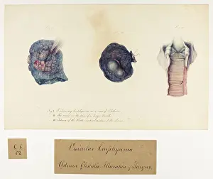 Ulceration: Vesicular Emphysema, Oedema glottides, Ulceration of Larynx