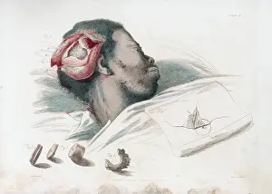 1821: View of wound in skull after trephination and