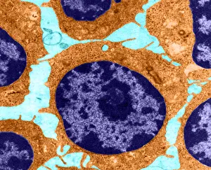 Microscopy: White Blood Cells in Leukemia (TEM)