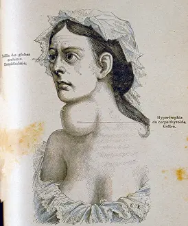 Caused: Woman with goitre, and enlargement of the thyroid