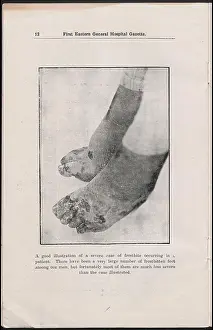 Toes: WW1 - First Eastern General Hospital Gazette
