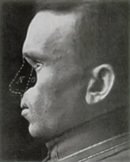 Deformed: WWI Veteran Needing Reconstructive Surgery