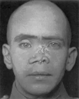 Deformed: WWI Veteran Needing Reconstructive Surgery