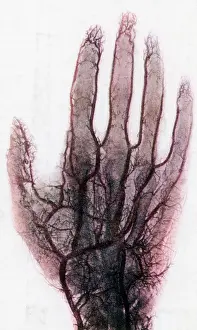 X Ray: X-ray of Blood Vessels