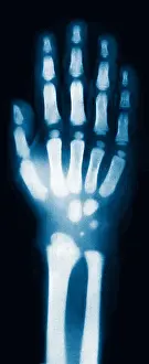 Eder: X-ray of Child's Hand, 1896
