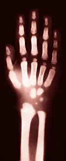 Fingers: X-ray of Child's Hand, 1896