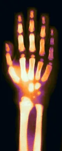 Fingers: X-ray of Child's Hand, 1896