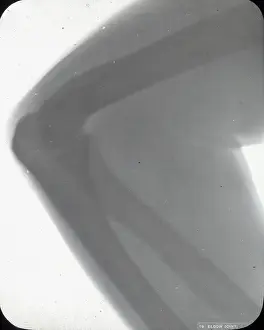 X Rays: X-Ray - Elbow Joint