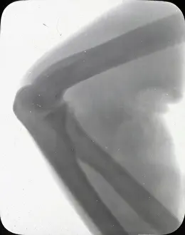 X Rays: X-Ray - Elbow Joint