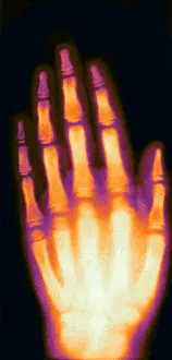 Fingers: X-ray of Girl's Hand, 1896