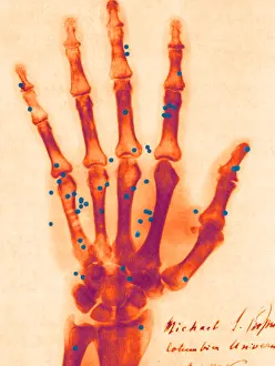 Xray: X-ray of Gunshot in the Hand