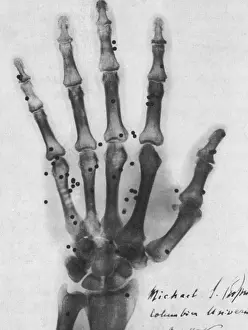 Xray: X-ray of Gunshot in the Hand