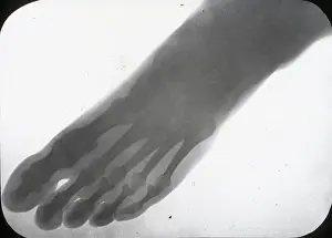 X Rays: X-Ray - Human Foot