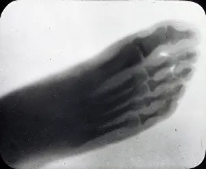 X Rays: X-Ray - Human Foot