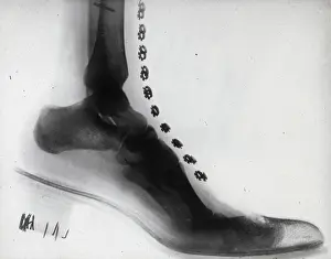 X Rays: X-Ray - Human Foot