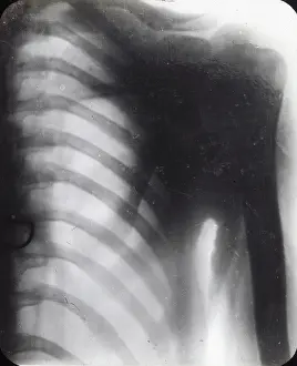 X Rays: X-Ray - Human Male Chest