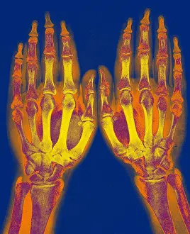 Normal: X-Ray of Two Normal Hands, 1896