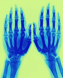 Normal: X-Ray of Two Normal Hands, 1896