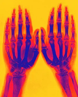 Normal: X-Ray of Two Normal Hands, 1896