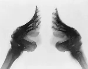 Alteration: X-ray of a woman's bound feet, China. Ca. ?