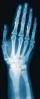 Fingers: X-ray of Woman's Hand, 1896
