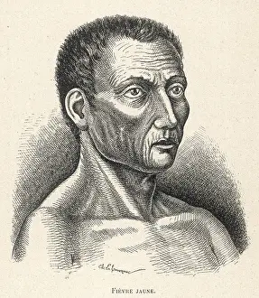 Ailments: YELLOW FEVER VICTIM